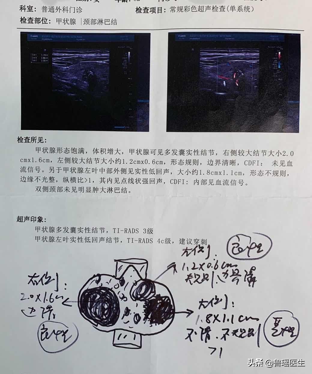 甲状腺滤泡癌病例分析,左侧颈部甲状腺癌有什么症状