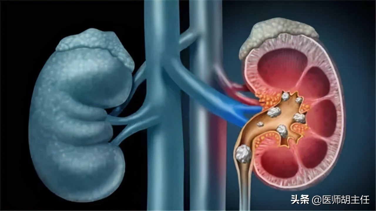 尿酸偏高又有肾结石怎么办,尿酸高引起的肾结石怎么反复发作