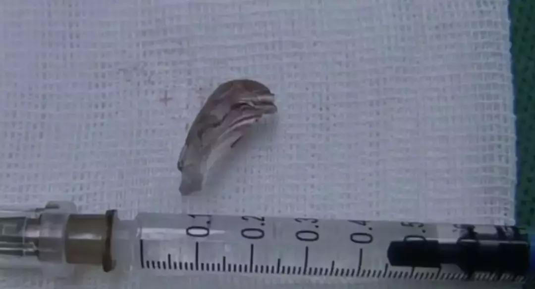 小孩子误食玻璃片怎么办,小孩吞了玻璃片有什么症状