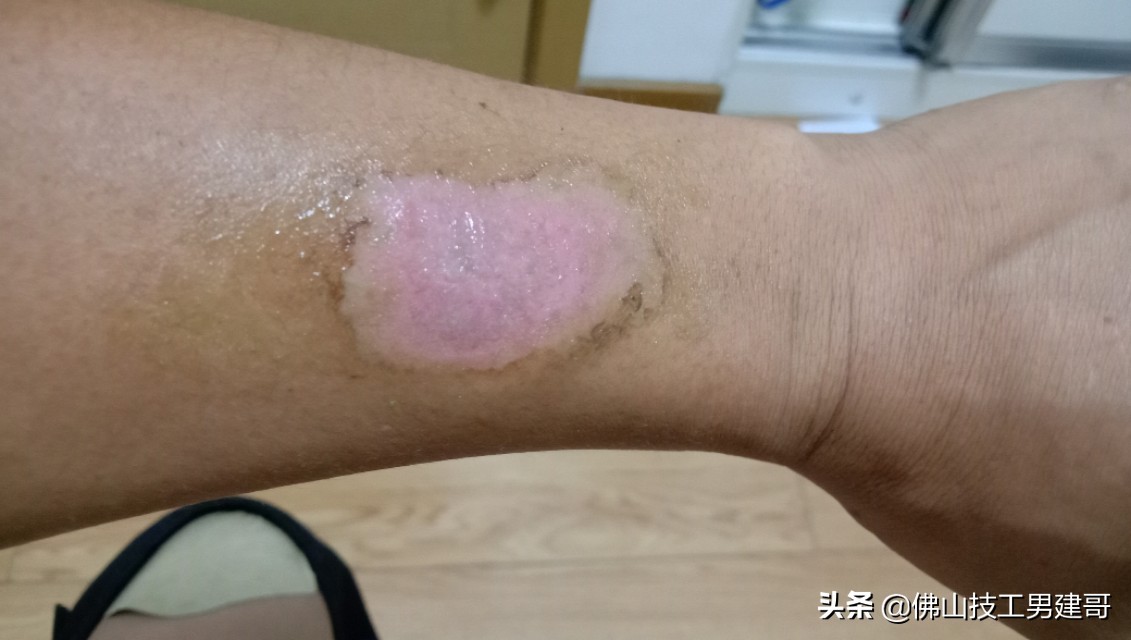 手部烫伤后的康复视频,手烫伤处理视频