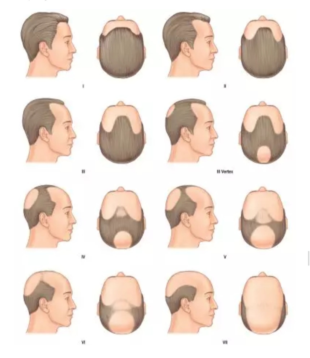 脱发掉发秃顶你该了解生发方法了,男士脱发秃顶怎么才能长出头发