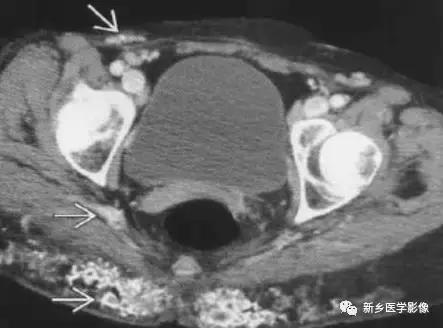 腹部平片能看到结石吗,腹部高密度结节影是什么