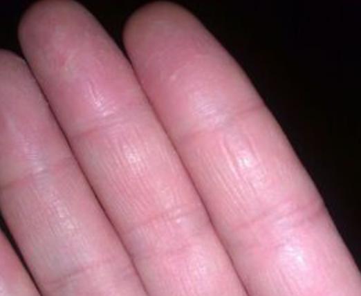 手指肚干瘪脱皮有褶皱原因,手指指腹干瘪起皱脱皮怎么办