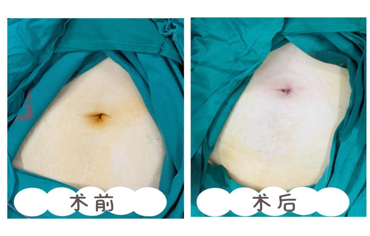 【技术】妇科无痕腔镜手术在南昌大学二附院妇产科成熟开展