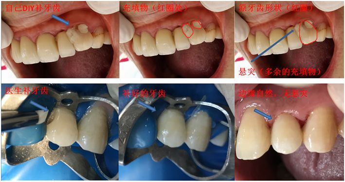 根管治疗后补牙多少钱一颗,根管治疗加补牙烤瓷牙费用