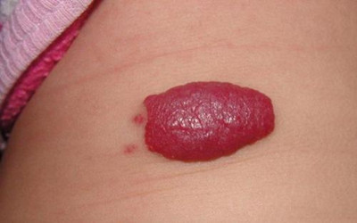 小孩身上的血管瘤饮食要注意什么,婴儿草莓状血管瘤需要注意什么