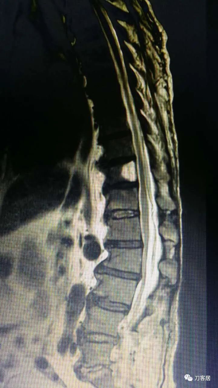 腰椎手术切掉棘突,腰突微创后出血肿