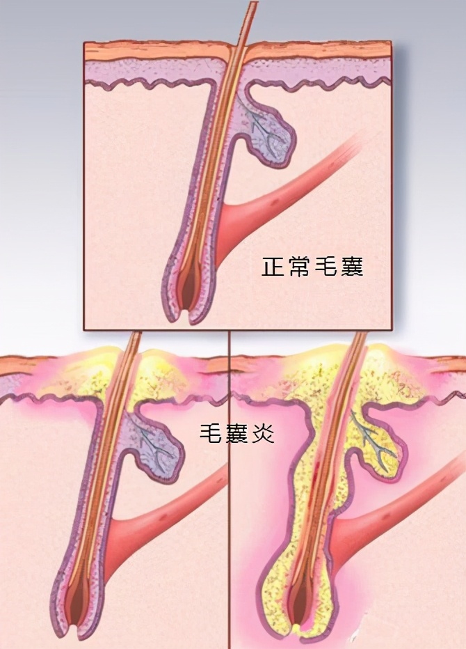 简述穿掘性毛囊炎的治疗方法