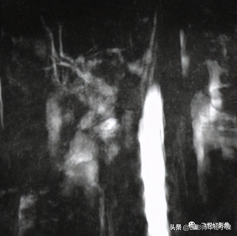 「飞利浦磁共振技术」胆道系统胆胰管水成像之3D_MRCP_BH