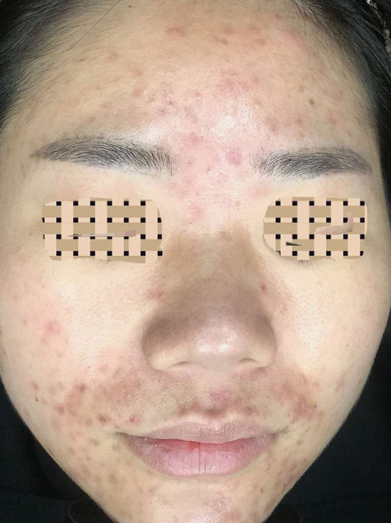 痘痘没了又长怎么解决,痘痘没了毛孔很大怎么办