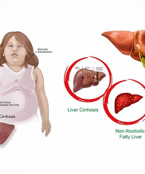 右上腹隐痛ct检查出脂肪肝,右上腹疼痛查出肝占位