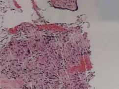 感觉身体淋巴结游走性疼痛,全身多处炎性淋巴结