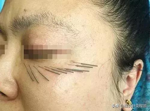 怎么治痘痘痘印最有效的方法,如何治好痘痘痘印最有效