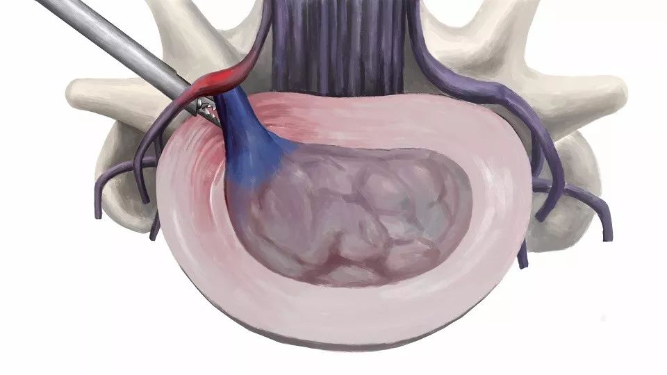 腰椎间盘突出椎管狭窄完整病历,腰椎间盘突出椎管狭窄中医辨证