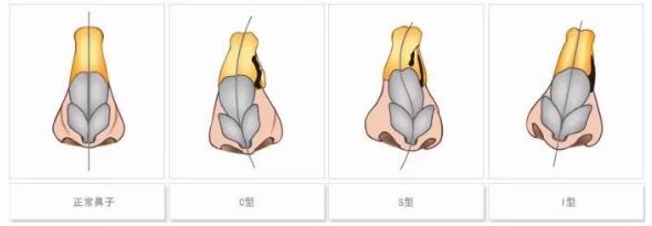鼻子有一点歪怎么自我矫正,鼻子歪斜矫正手术多少钱