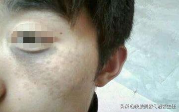 脸上有黑色素沉着斑怎能治好,脸上有色斑的护肤教程