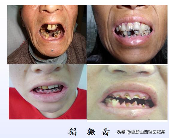 牙齿变黑是哪种疾病的前兆,牙齿全黑腐烂是什么引起的
