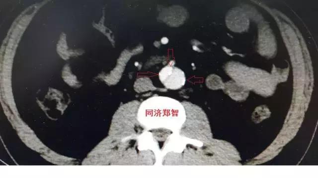 磁共振可以替代cta检查主动脉夹层,主动脉夹层cta上如何分辨真假腔