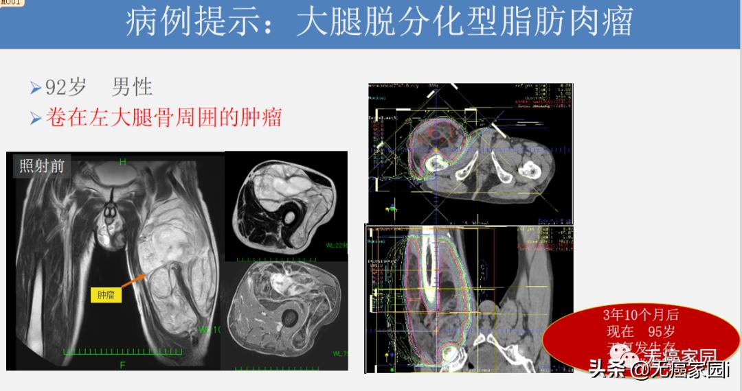 质子治疗手术适合大型肿瘤,肿瘤不能根治吗