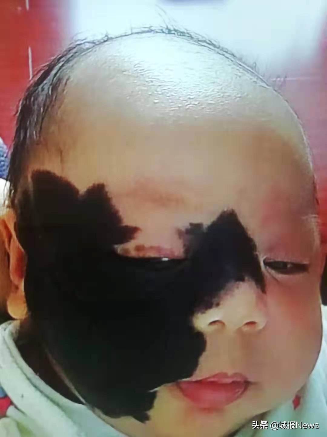 巨痣宝宝治疗费用,巨痣男童