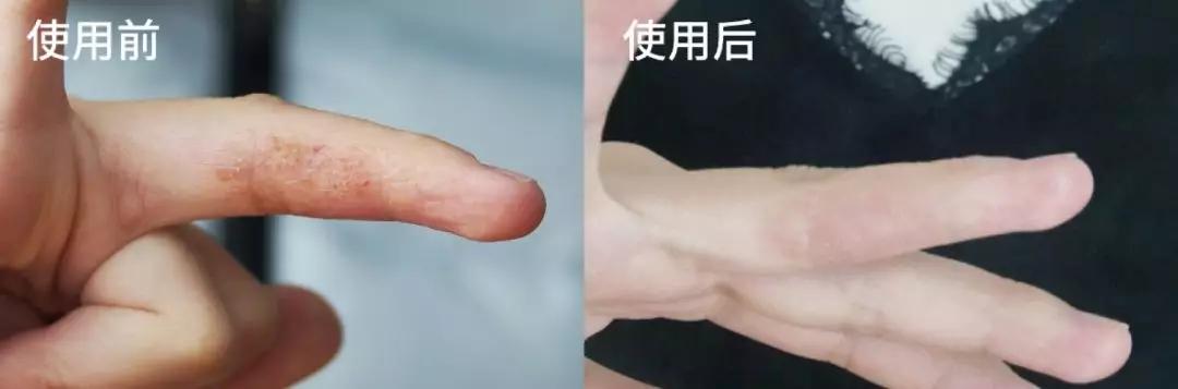 蜂胶消炎祛痘,蜂胶治疗皮癣吗