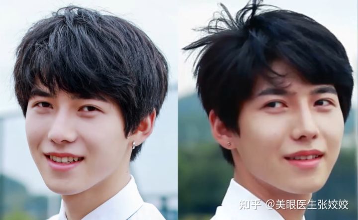 男生做双眼皮是全割还是埋线,男生肉眼泡双眼皮手术