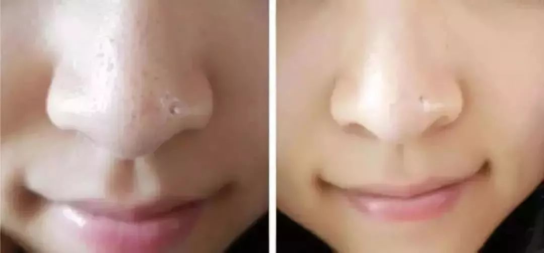 解决黑头的2种药,解决黑头的最好方法