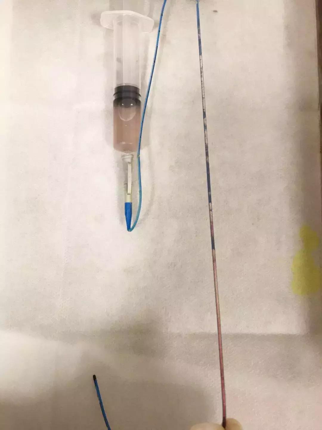 picc堵管了直接拔掉可以吗,化疗用的picc管堵了什么原因