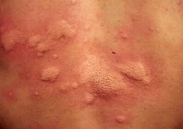 痒痒怎么办小妙招,痒痒用什么方法可以缓解