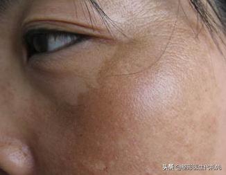 褐斑成因,褐斑的形成原因和治疗方法