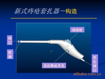 内痔套扎疗效好，并发症少，是国际公认最佳的门诊治疗方法