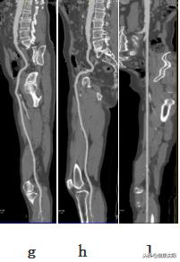 cta和血管造影怎么选择,血管oct检查与血管造影检查的区别