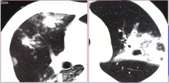 肺部ct十大征象,肺部ct正常图和异常图的区别