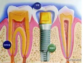 烤瓷牙价格表图种植牙,种植牙与烤瓷牙利与弊