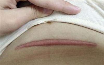 剖腹产现在是横切口还是竖切,剖腹产现在横切还是竖切