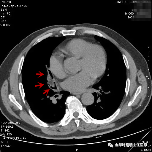 警惕反复发烧,警惕反复感染