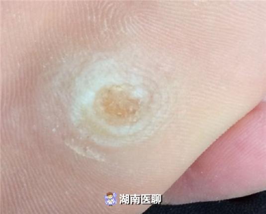 跖疣和鸡眼拔除全过程,切记不要把跖疣当作鸡眼处理