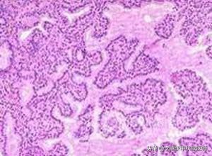 甲状腺亚甲炎右侧疼能自愈吗,甲状腺引起的不适