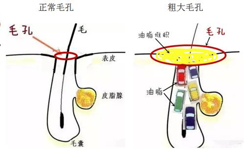 收缩毛孔最有效的方法非手术,收缩毛孔这3个办法真的很实用