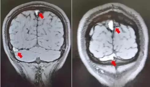 26岁小伙熬夜加班,23岁小伙熬夜突然头痛