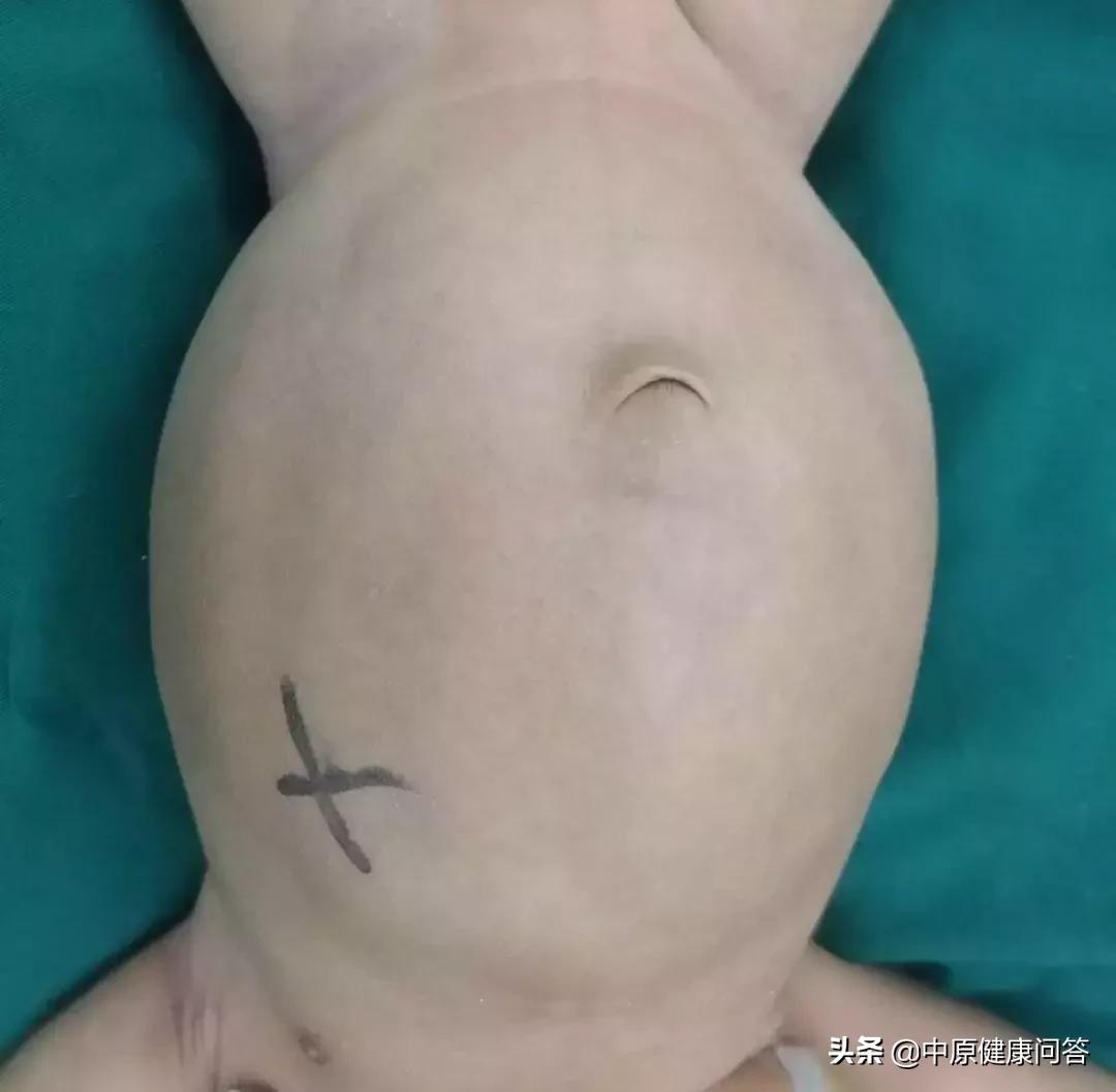 小孩怎么发现泌尿系统畸形,儿童肚子大鼓鼓的需要检查什么