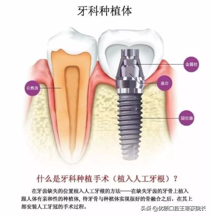 拔了一侧的两颗牙齿如何镶牙,镶一颗牙两侧牙齿不好怎么办