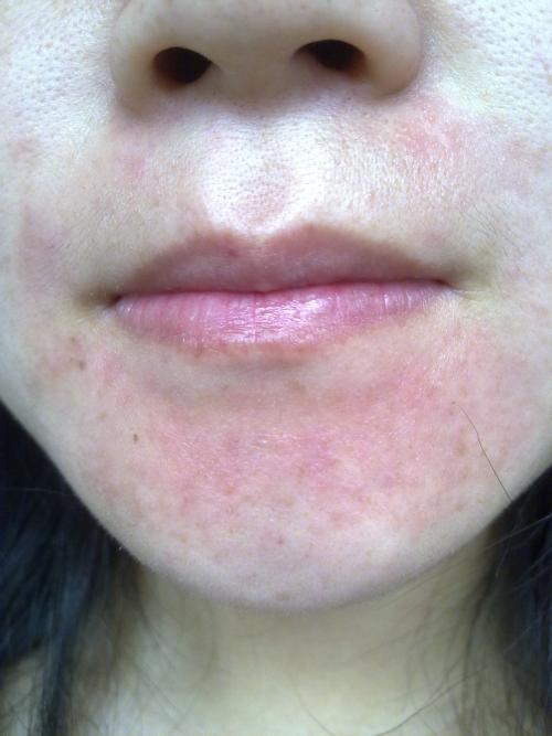 敏感肌皮肤过敏要怎么办,敏感肌脸部过敏最简单的处理方法