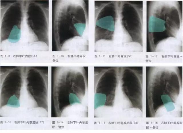 详细的胸部X线解剖，最基础最实用！