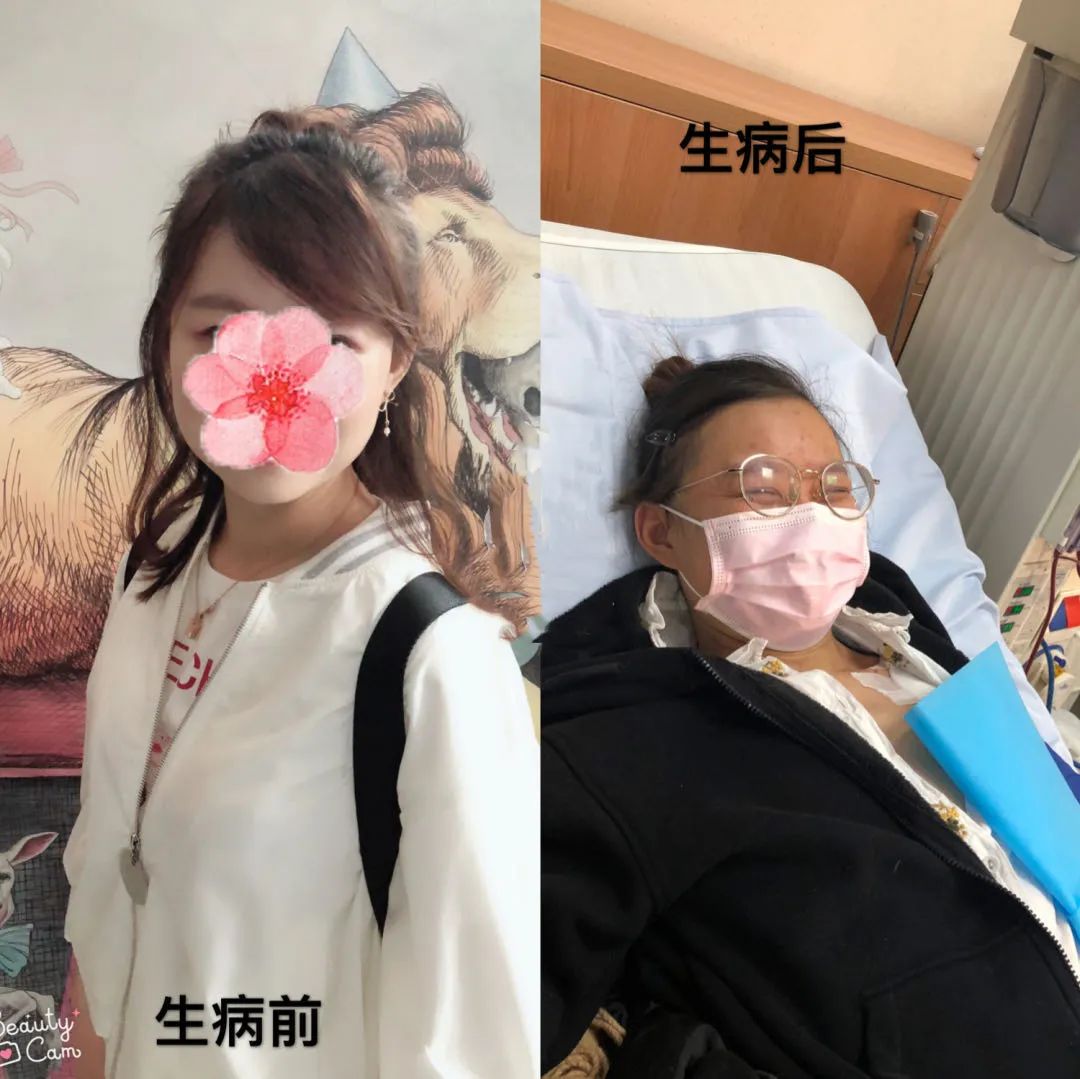 2年，从肌酐100到透析！绝望中的自我救赎之路