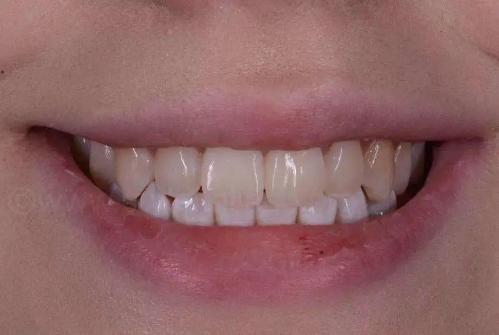 牙齿上有白斑是缺氟还是氟多了,儿童新长的牙有白斑黄斑会烂掉吗