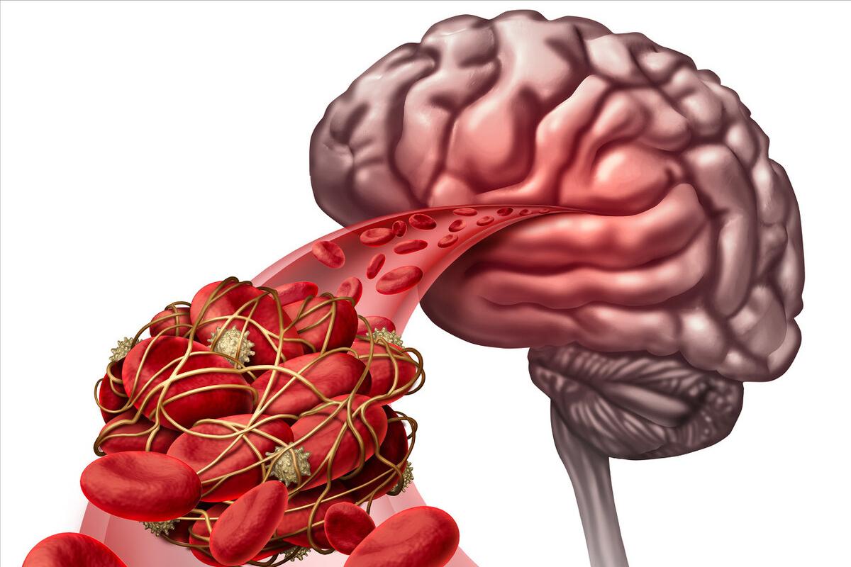 肌肉无力注意事项,肌肉无力症治疗方法