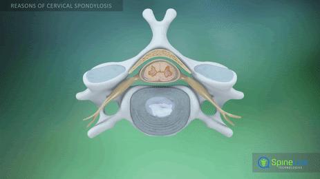 颈椎骨刺压迫神经怎么治疗,颈椎间盘突出压迫神经的症状