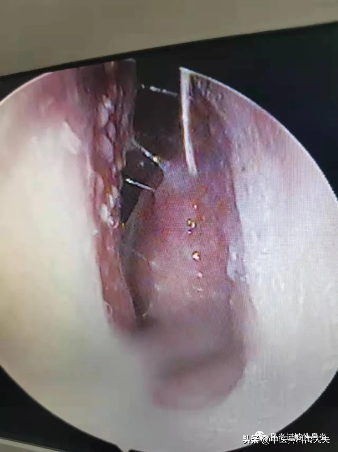鼻炎的症状和治疗最好方法,常见萎缩性鼻炎或干燥性鼻炎症状