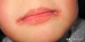 玻璃瓶划伤了怎么办,玻璃瓶划破手怎么处理